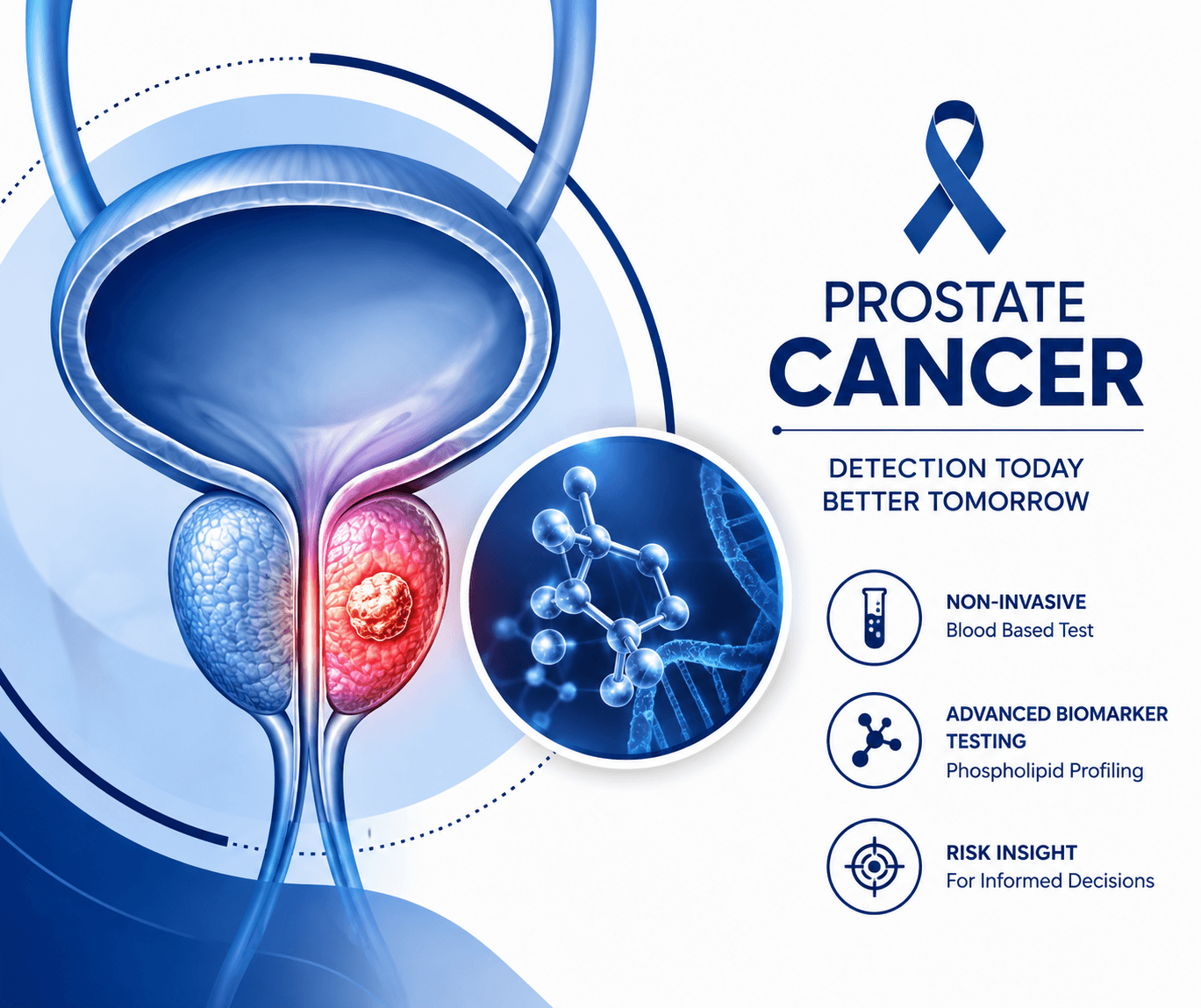 Prostate cancer biomarker overview showing blood-based testing, phospholipid profiling, and risk insight